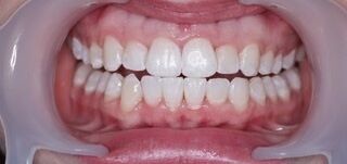 Invisalign after Picture