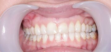 Invisalign after Picture